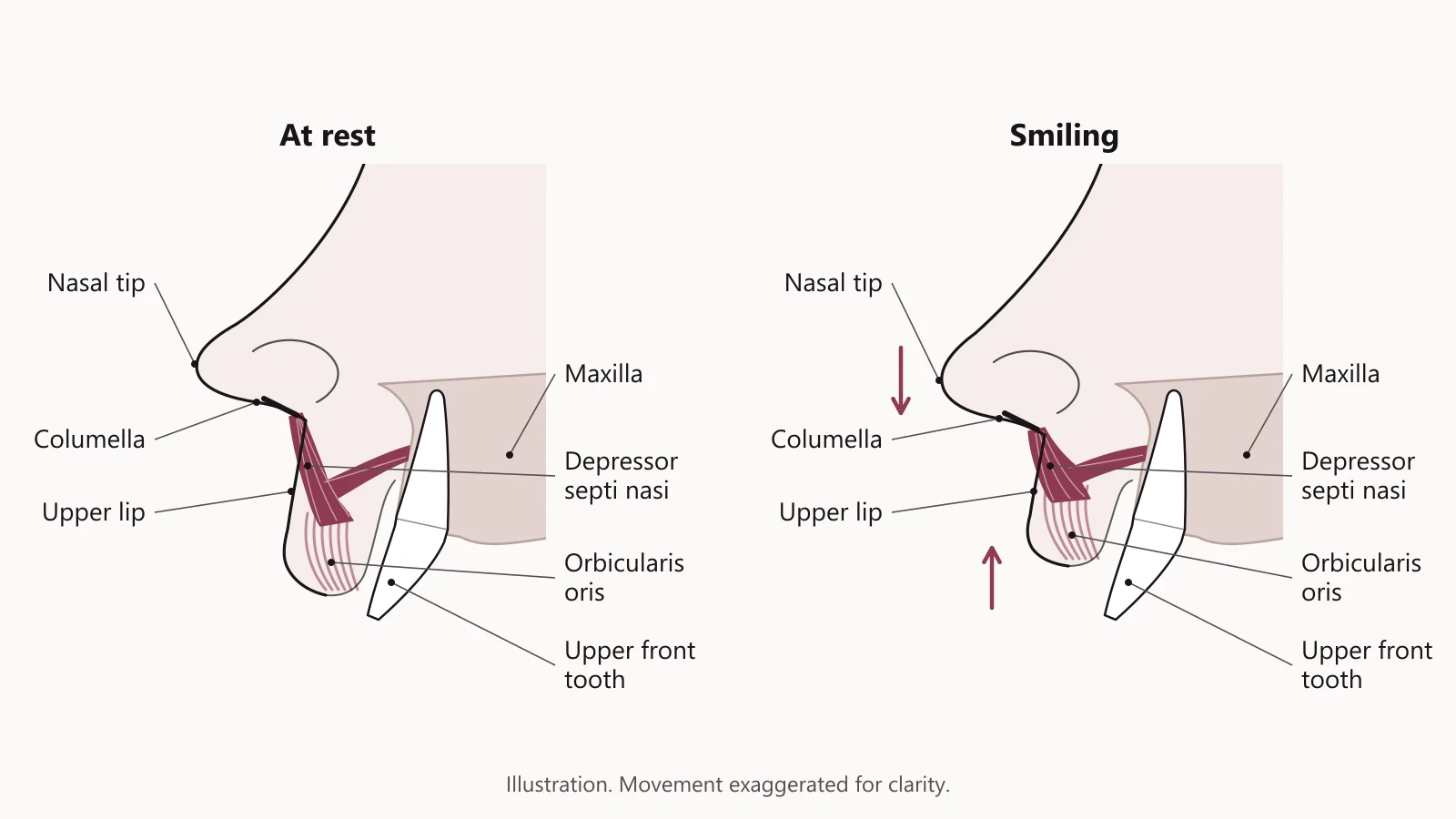 Side view of the lower nose and upper lip at rest and smiling, showing the depressor septi nasi muscle pulling the nasal tip down and shortening the upper lip.