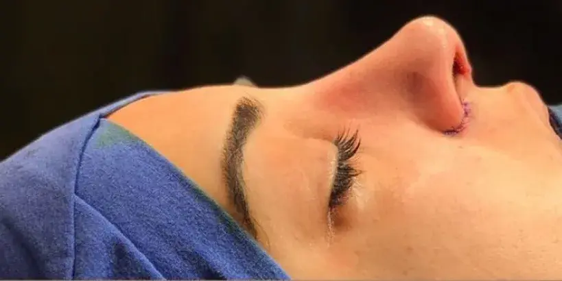 Case 1, the same nose at the end of the operation.