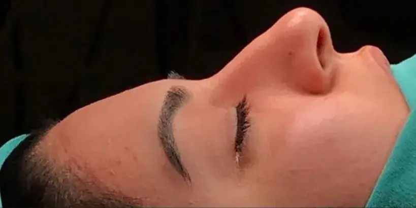 Case 1, the nose in profile before the operation.
