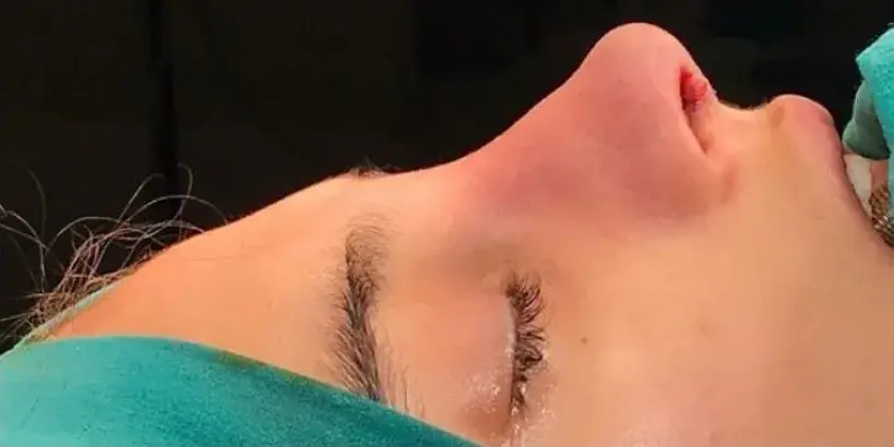 Case 2, the same nose at the end of the operation.