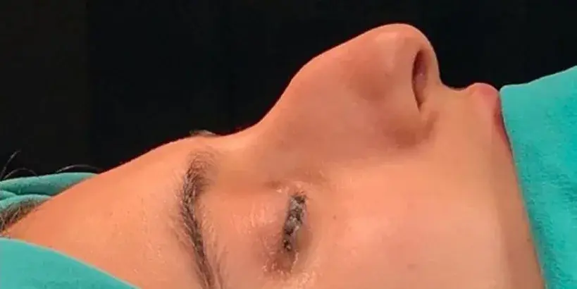 Case 2, the nose in profile before the operation.