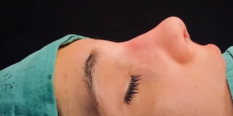 Case 3, the same nose at the end of the operation.