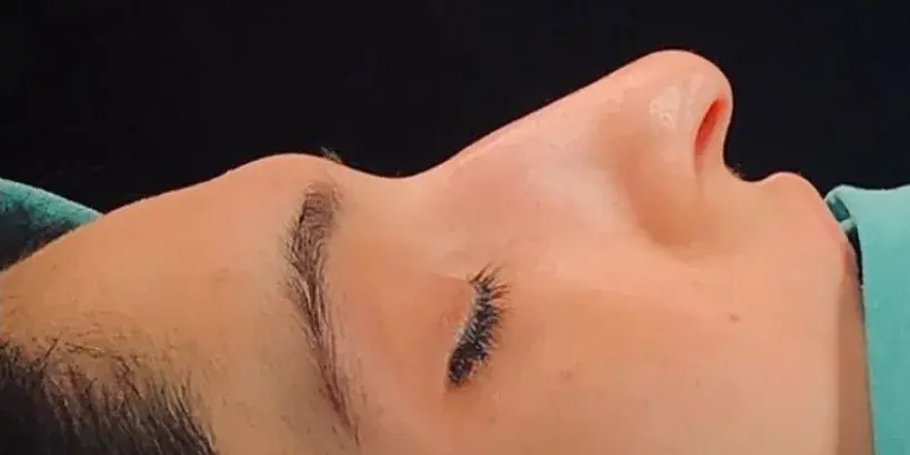 Case 3, the nose in profile before the operation.