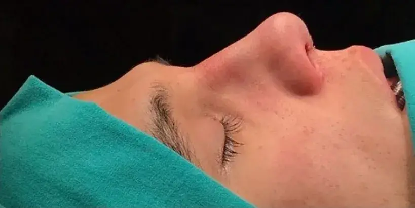 Case 4, the same nose at the end of the operation.