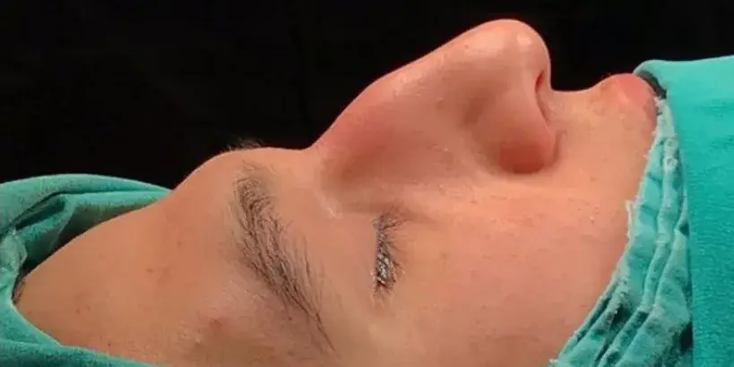 Case 4, the nose in profile before the operation.