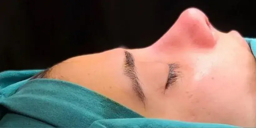 Case 5, the same nose at the end of the operation.