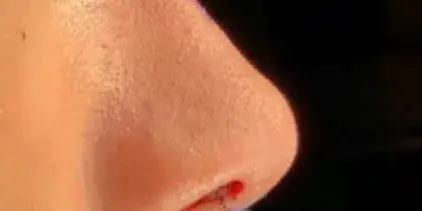 Case 1, the same nose at the end of the operation.