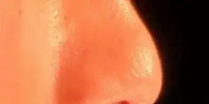 Case 1, the nose in profile before the operation.