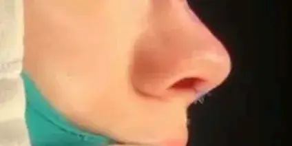 Case 2, the same nose at the end of the operation.