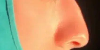 Case 2, the nose in profile before the operation.
