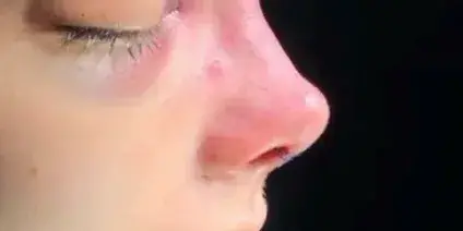 Case 3, the same nose at the end of the operation.