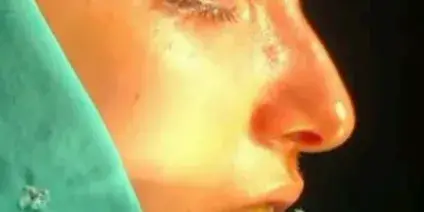 Case 3, the nose in profile before the operation.
