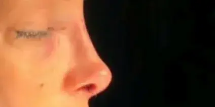 Case 4, the same nose at the end of the operation.
