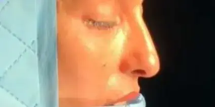 Case 4, the nose in profile before the operation.