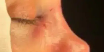 Case 5, the same nose at the end of the operation.