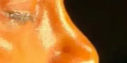 Case 5, the nose in profile before the operation.