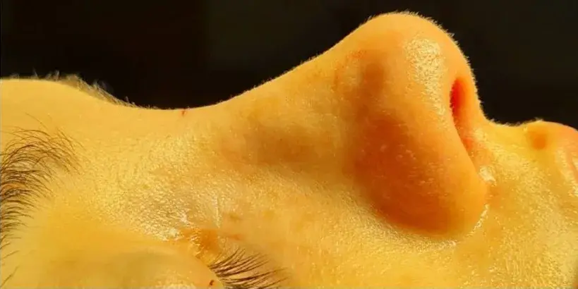 Case 1, the same nose at the end of the operation.