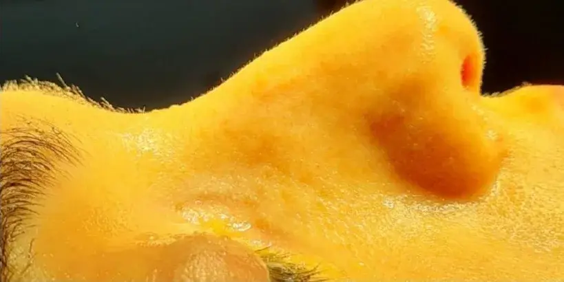Case 1, the nose in profile before the operation.