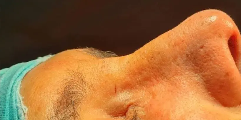 Case 2, the same nose at the end of the operation.