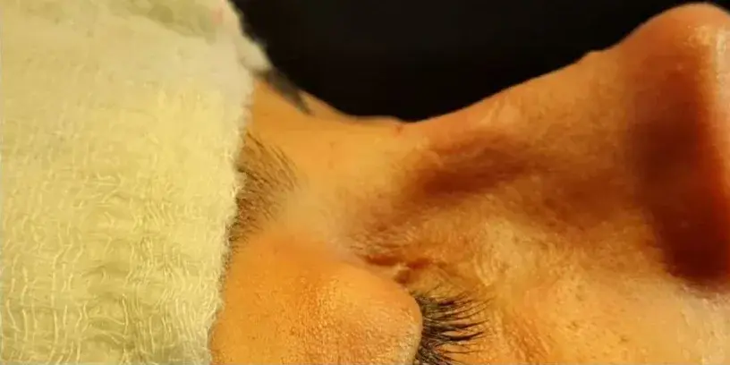 Case 3, the same nose at the end of the operation.