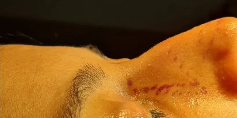 Case 3, the nose in profile before the operation.
