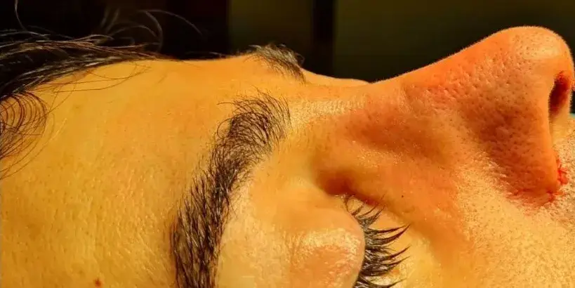 Case 4, the same nose at the end of the operation.