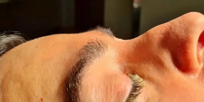 Case 4, the nose in profile before the operation.