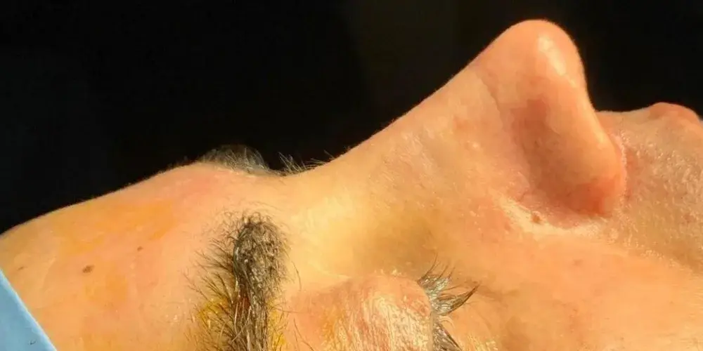 Case 5, the same nose at the end of the operation.