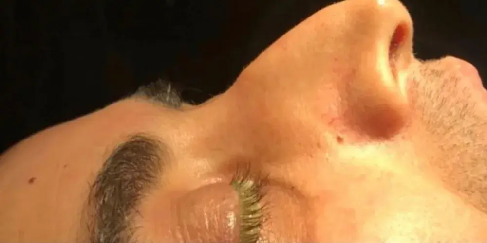 Case 5, the nose in profile before the operation.