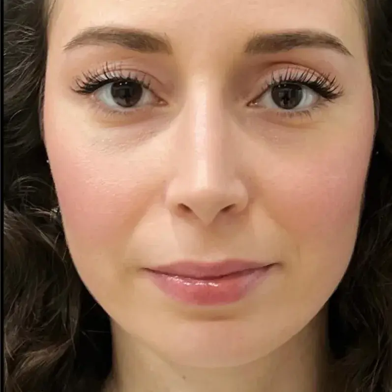 Case 1, the same nose after it had healed.