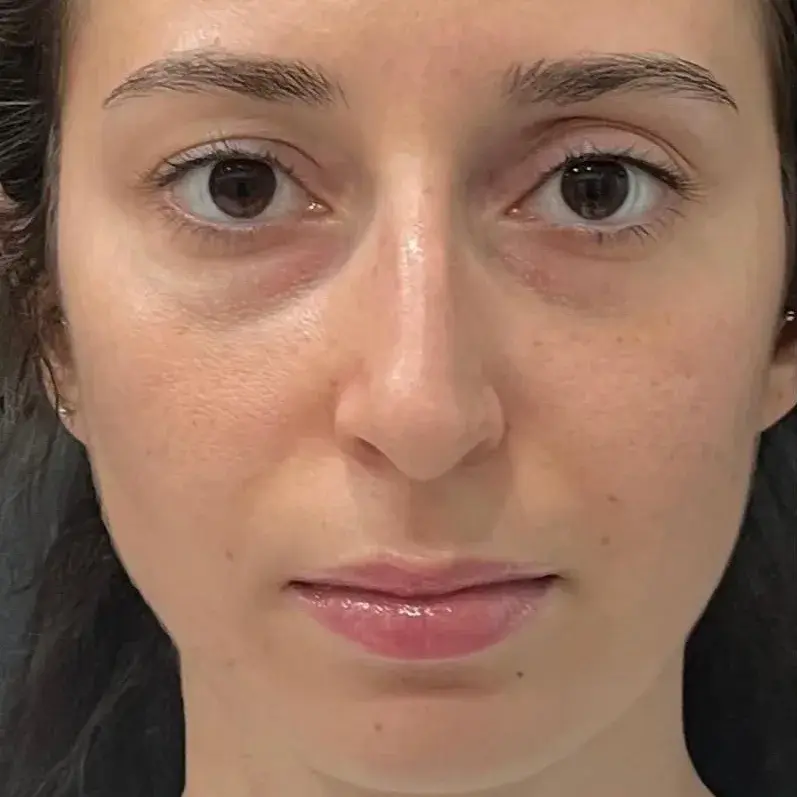 Case 1, the nose in profile before the operation.