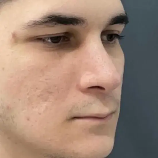 Case 2, the same nose after it had healed.