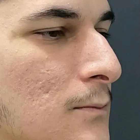 Case 2, the nose in profile before the operation.