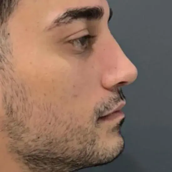 Case 3, the same nose after it had healed.