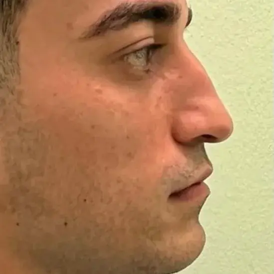 Case 3, the nose in profile before the operation.