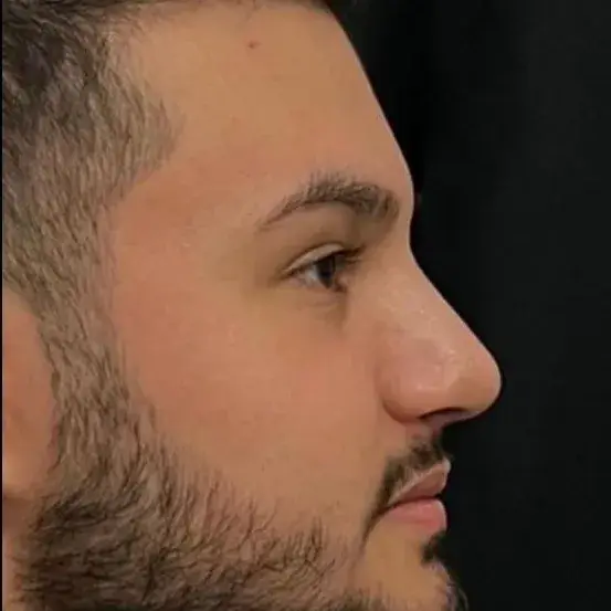 Case 5, the same nose after it had healed.