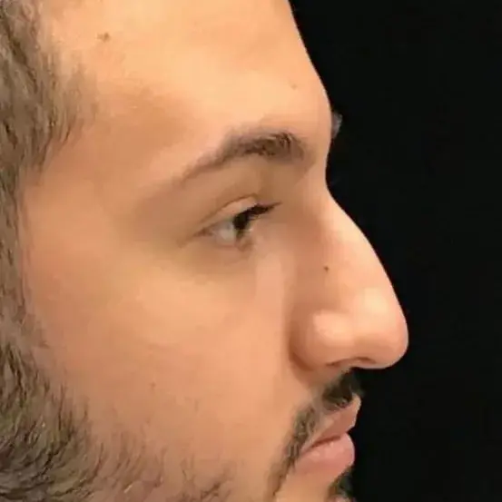 Case 5, the nose in profile before the operation.