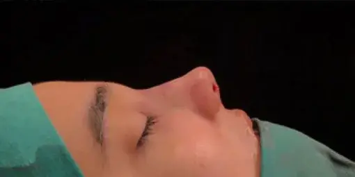 Case 1, the same nose at the end of the operation.