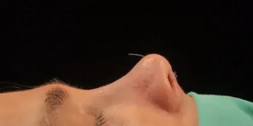 Case 2, the same nose at the end of the operation.