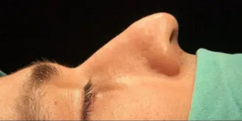 Case 2, the nose in profile before the operation.