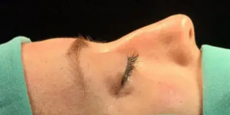 Case 3, the nose in profile before the operation.
