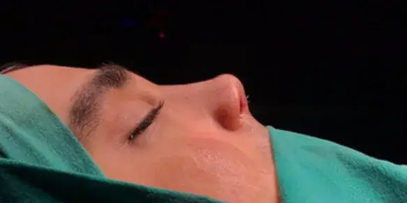 Case 4, the same nose at the end of the operation.