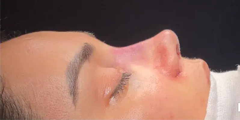 Case 1, the same nose at the end of the operation.