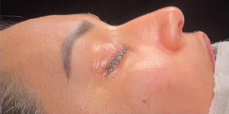 Case 1, the nose in profile before the operation.