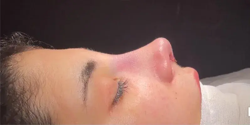 Case 2, the same nose at the end of the operation.