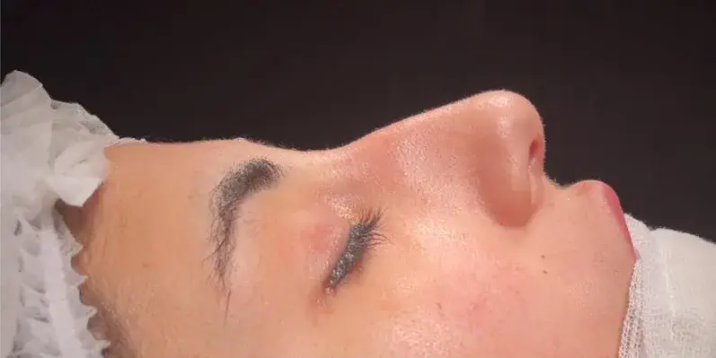 Case 2, the nose in profile before the operation.