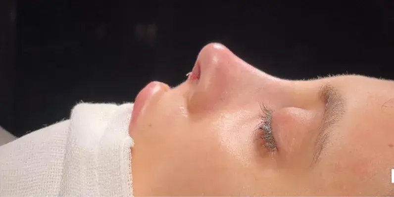 Case 4, the same nose at the end of the operation.