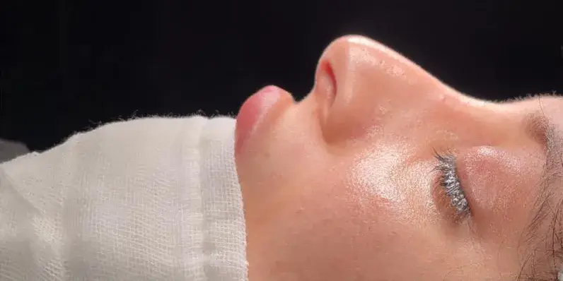Case 4, the nose in profile before the operation.