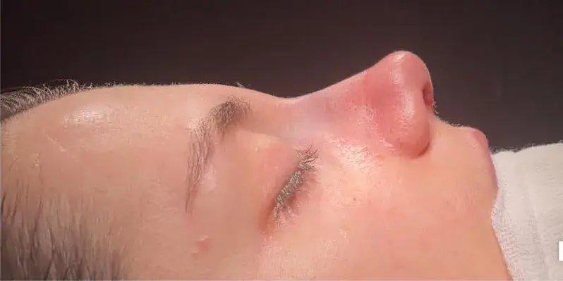 Case 5, the same nose at the end of the operation.