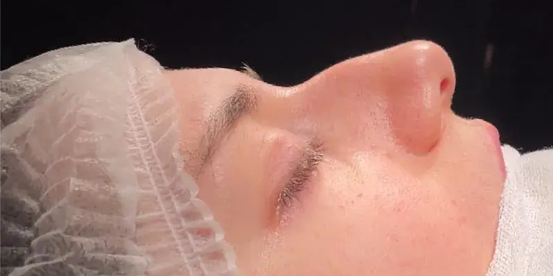 Case 5, the nose in profile before the operation.